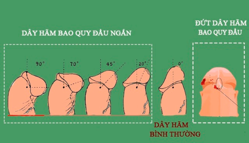 Đứt &quot;phanh hãm&quot; khi yêu, không thể chủ quan - Ảnh 1.