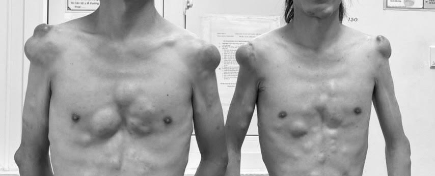 Căn bệnh khiến 2 anh em sinh đôi mọc hàng trăm khối u trên cơ thể như &quot;người củi&quot; - Ảnh 1.