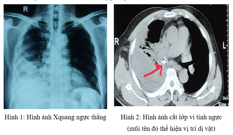 Xử trí thành công dị vật phế quản phức tạp cho bệnh nhân nam do sặc thịt gà - Ảnh 1.