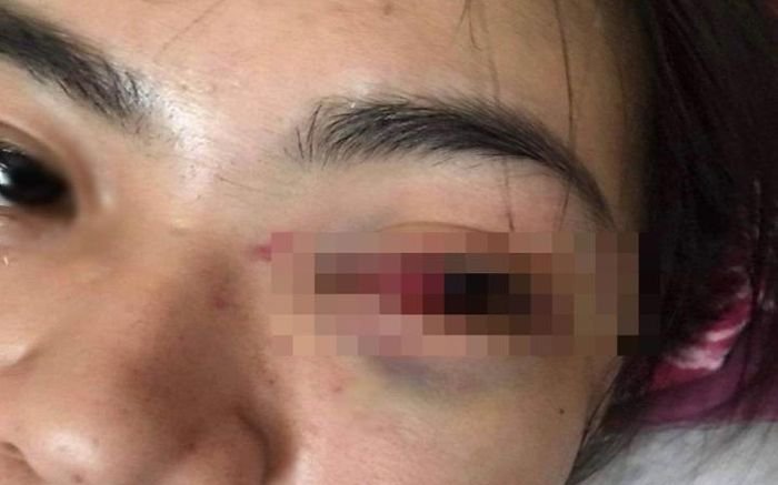 Nữ sinh ở Hà Tĩnh bị nhóm bạn đánh hội đồng dẫn đến tụ máu mắt