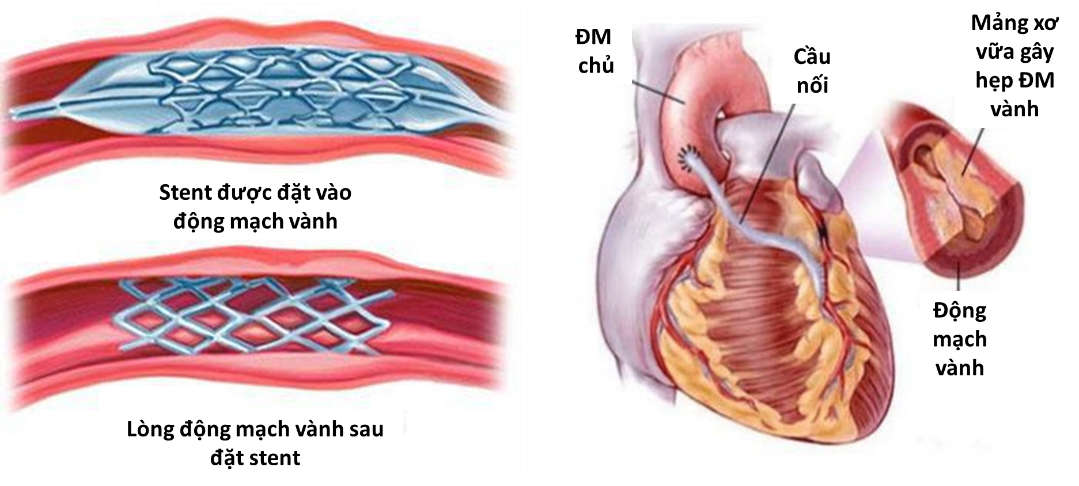 Các dấu hiệu nhận biết bệnh nhồi máu cơ tim cấp