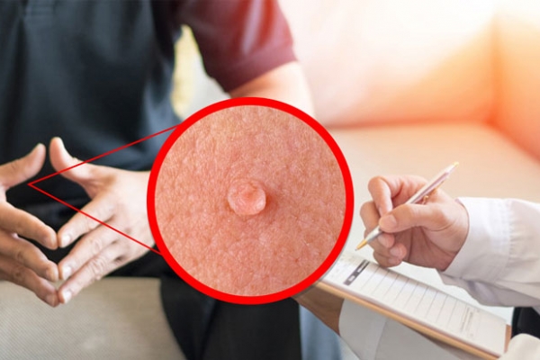 Bệnh tình dục gia tăng ở nhóm người trẻ, có người điều trị sùi mào gà 15 lần không khỏi - Ảnh 2. Bệnh tình dục gia tăng ở nhóm người trẻ, có người điều trị sùi mào gà 15 lần không khỏi - Ảnh 2.