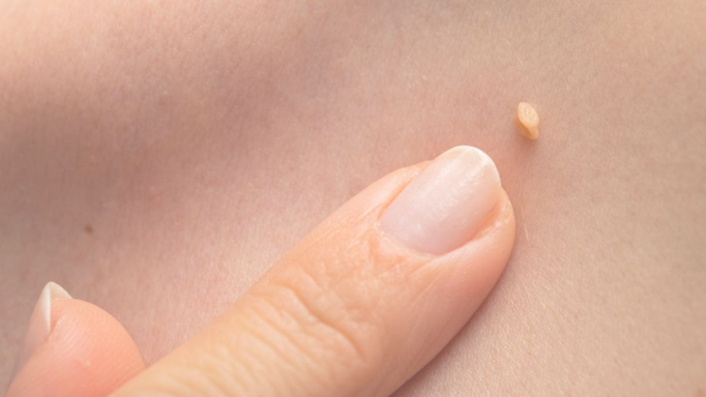 Bệnh tình dục gia tăng ở nhóm người trẻ, có người điều trị sùi mào gà 15 lần không khỏi - Ảnh 3. Bệnh tình dục gia tăng ở nhóm người trẻ, có người điều trị sùi mào gà 15 lần không khỏi - Ảnh 3.