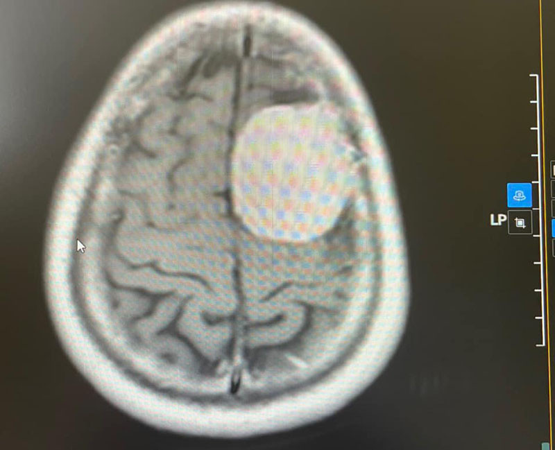 Phát hiện khối u lớn trong não sau cơn đau đầu dữ dội - Ảnh 1.