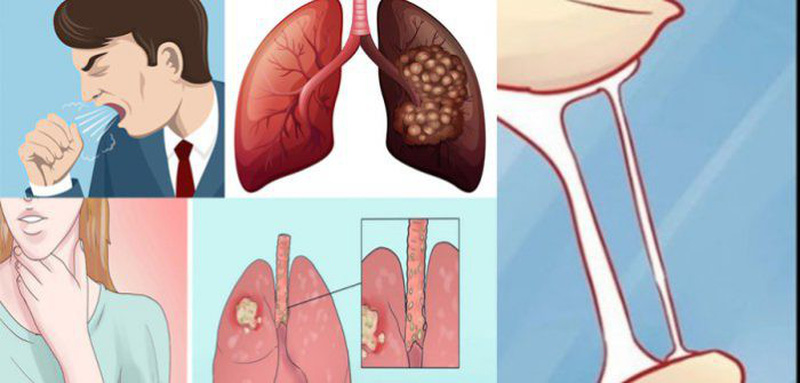 BS chuyên khoa khuyến cáo: Dấu hiệu nhận biết 5 loại ung thư phổ biến tại Việt Nam hiện nay - Ảnh 2.