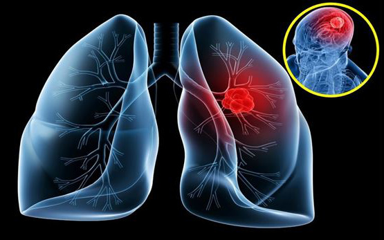 NSƯT Tiến Hợi qua đời vì ung thư phổi: 4 dấu hiệu dễ nhận biết nhất nhưng rất dễ bị bỏ qua