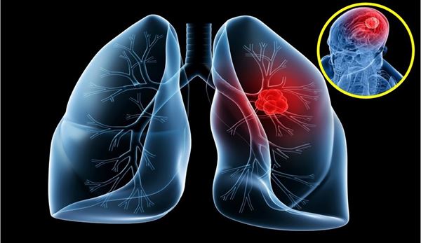 NSƯT Tiến Hợi qua đời vì ung thư phổi: 4 dấu hiệu dễ nhận biết nhất nhưng rất dễ bị bỏ qua! - Ảnh 3.