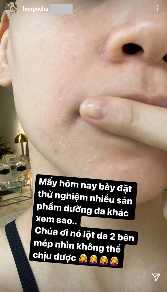 6 sao Việt từng bong da, mẩn đỏ khắp mặt vì skincare - Ảnh 2.