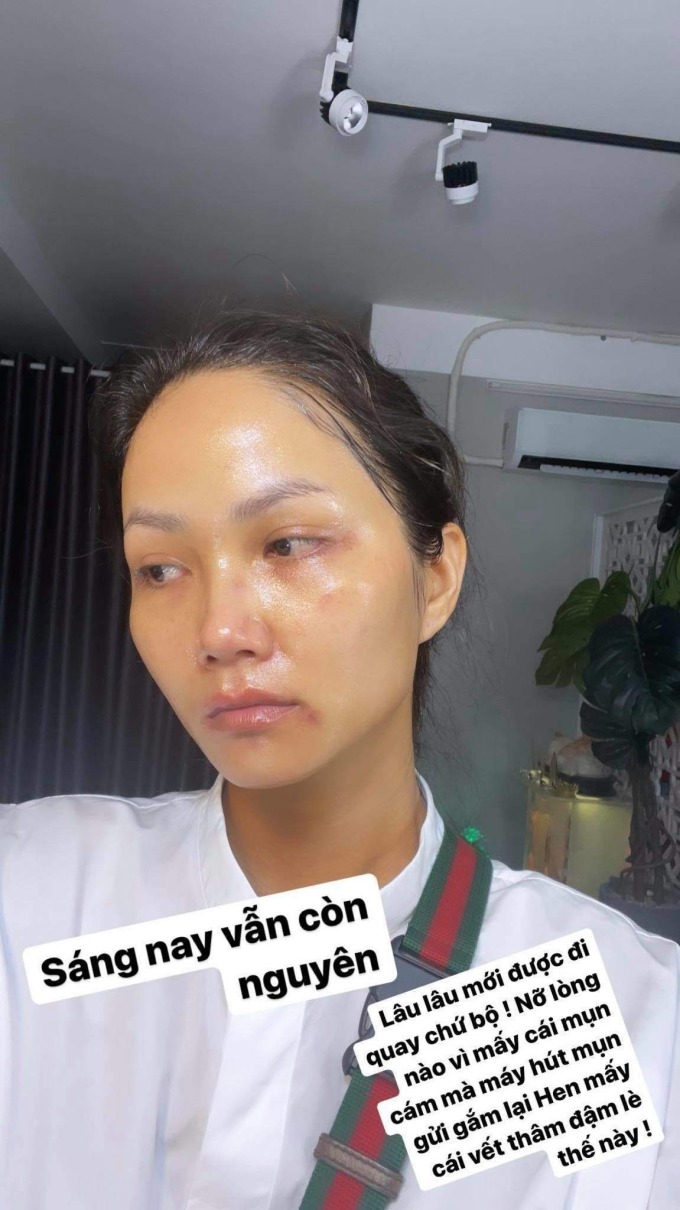 6 sao Việt từng bong da, mẩn đỏ khắp mặt vì skincare - Ảnh 6.