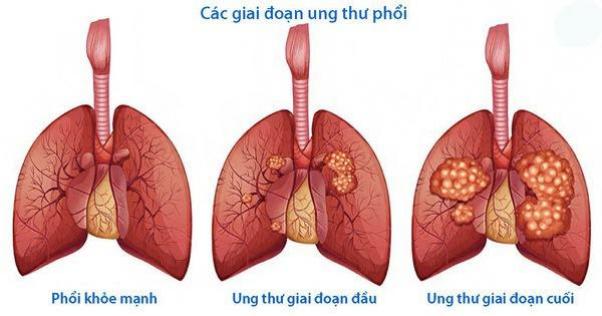 Là cựu vận động viên bóng rổ nhưng lại bị ung thư phổi giai đoạn 4 dù chưa bao giờ hút thuốc, bà mẹ 2 con đưa ra khuyến cáo đắt giá cho chị em - Ảnh 4.