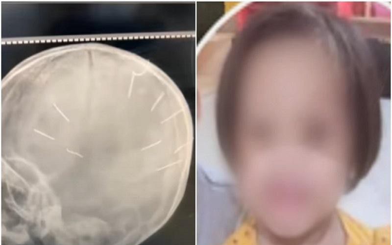 Diễn biến mới nhất về sức khỏe của bé gái 3 tuổi bị người tình của mẹ đóng 9 đinh vào đầu