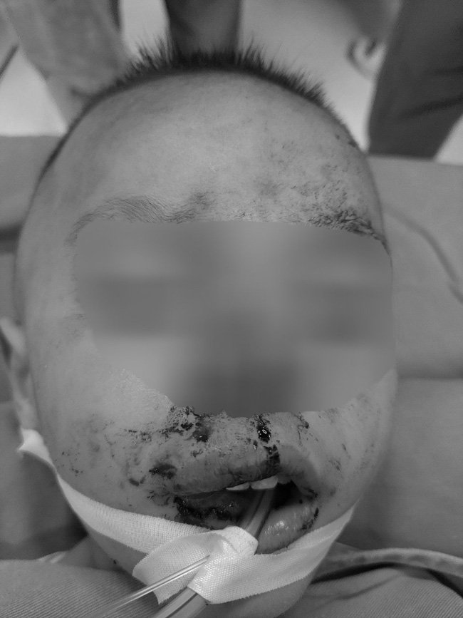 Bé trai 2 tuổi bị chó nhà hàng xóm cắn dã man, nhập viện với chi chít vết thương trên mặt - Ảnh 1.