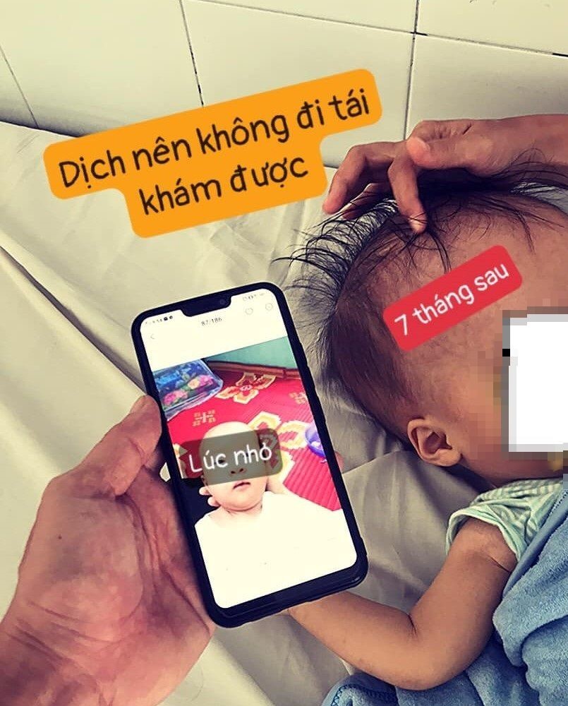 Cậu bé 4 tháng tuổi làm con nuôi bệnh viện vì mang chiếc đầu 'bự' - Ảnh 3.