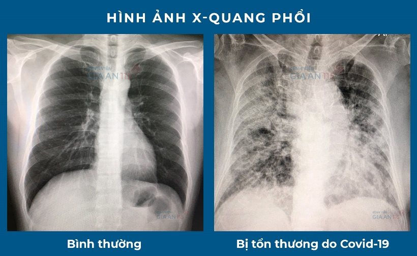 Hậu COVID -19 và những điều có thể bạn chưa biết - Ảnh 2.