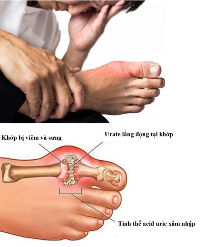 Những sai lầm trong điều trị bệnh gout cần tránh - Ảnh 2.