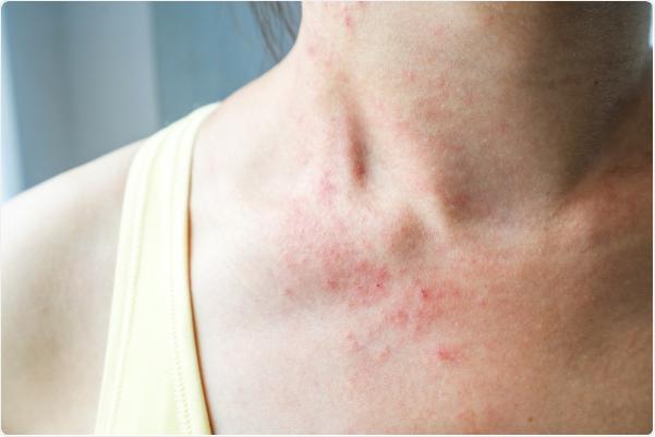 Tự ti vì da nổi mụn, mẩn đỏ trông ‘bẩn bẩn’ hậu COVID-19, nhiều chị em chữa sai cách khiến tình trạng nặng thêm - Ảnh 1.