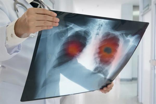 Các yếu tố âm thầm tăng nguy cơ ung thư phổi - Ảnh 1.