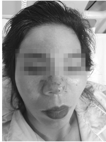 Chi gần triệu ti&ecirc;m filler thử xem c&oacute; hợp, hỏng thật cả mũi, mặt - Ảnh 1.