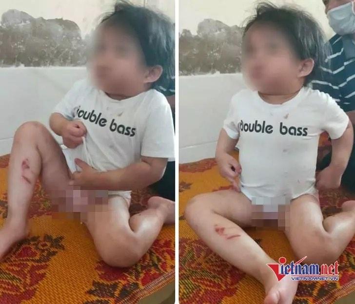 Công an thông tin vụ dì ruột đánh cháu 4 tuổi nhập viện vì lười ăn - Ảnh 1. Công an thông tin vụ dì ruột đánh cháu 4 tuổi nhập viện vì lười ăn - Ảnh 1.