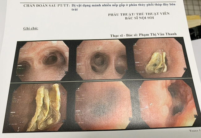 Ho dai dẳng suốt một năm, tưởng do Covid-19, đi khám mới phát hiện thủ phạm bất ngờ - Ảnh 1.