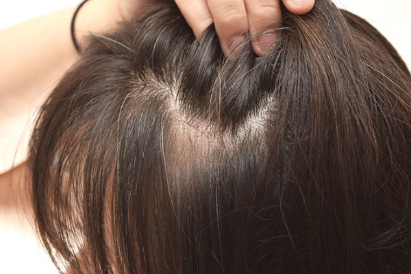 Sự thật về tóc bạc sớm, đây là 5 lý do không nên nhổ nếu không muốn bị hói sớm  - Ảnh 2.
