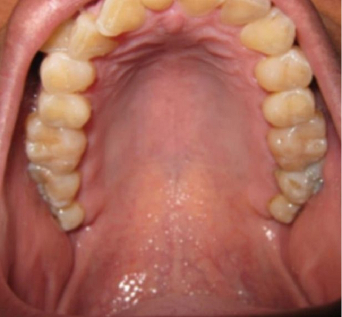 4 dấu hiệu cảnh báo ung thư miệng, phát hiện sớm có thể cứu sống bạn - Ảnh 2.