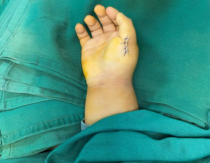 Bé 23 tháng tuổi dị tật thừa ngón tay - Ảnh 1.