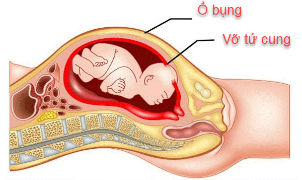 Từ vụ thai phụ nguy hiểm tính mạng do bị vỡ tử cung: Những ai dễ gặp loại tai biến sản khoa này? - Ảnh 3.