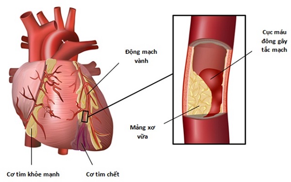 5 nguyên nhân phổ biến khiến quý ông dễ bị “bất lực” - Ảnh 4.