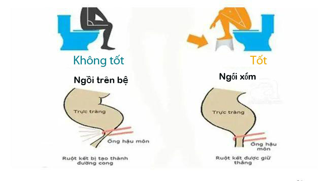 Ngồi xổm hay ngồi trên bệ khi đi vệ sinh tốt cho sức khỏe hơn? Cách ngồi sai dễ gây bệnh nhiều người mắc - Ảnh 2. Ngồi xổm hay ngồi trên bệ khi đi vệ sinh tốt cho sức khỏe hơn? Cách ngồi sai dễ gây bệnh nhiều người mắc - Ảnh 2.