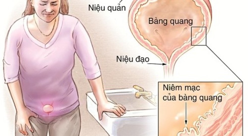 Cách đơn giản để ngăn ngừa nhiễm trùng đường tiết niệu do quan hệ tình dục - Ảnh 2.