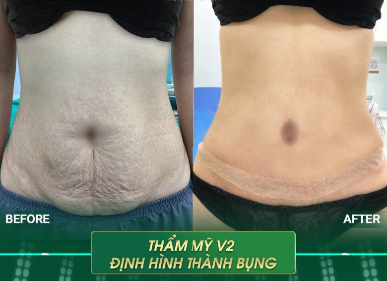 Sau nhiều năm hút mỡ bụng, tạo hình chiếc rốn của Thúy Vi trông lạ lẫm - Ảnh 9.