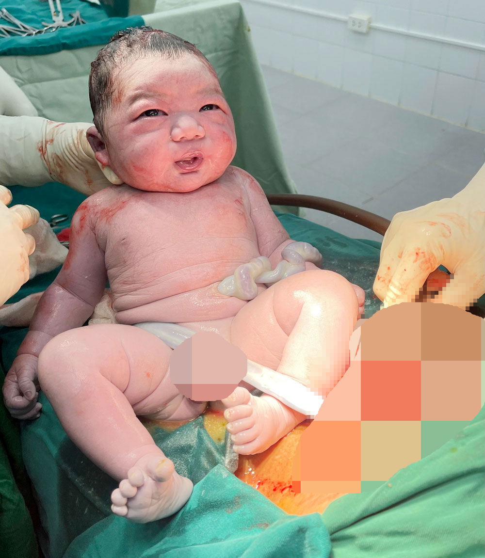 Bắc Giang: Cấp cứu mổ lấy thai cho sản phụ 94 kg, bé trai chào đời nặng 5 kg - Ảnh 2.
