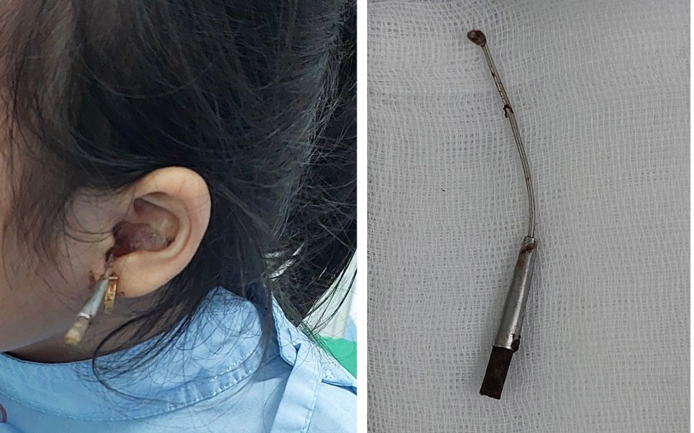 Kinh hãi bé gái 6 tuổi bị cây lấy dáy tai đâm xuyên vào tai giữa, bài học cho nhiều gia đình!