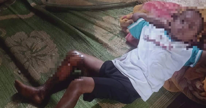 Vụ b&eacute; 8 tuổi bị đốt ch&acirc;n: Th&ocirc;ng tin ch&iacute;nh thức từ c&ocirc;ng an - Ảnh 1.