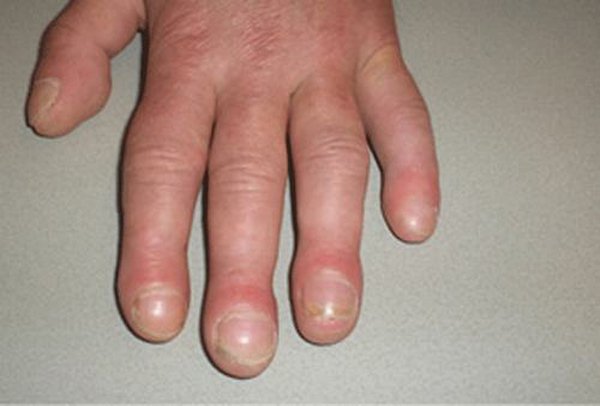 Dấu hiệu từ móng tay cảnh báo bệnh, rất có thể cơ thể bạn đang thiếu chất trầm trọng - Ảnh 3.