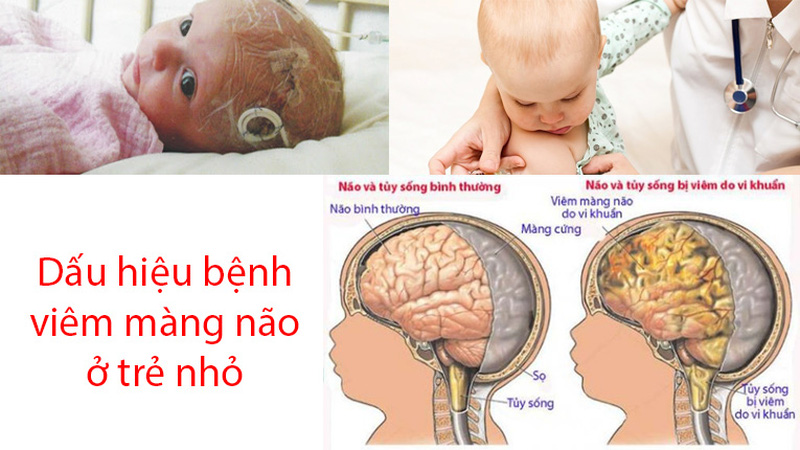 Những dấu hiệu nào báo hiệu bệnh viêm màng não ở trẻ em? - Ảnh 1.