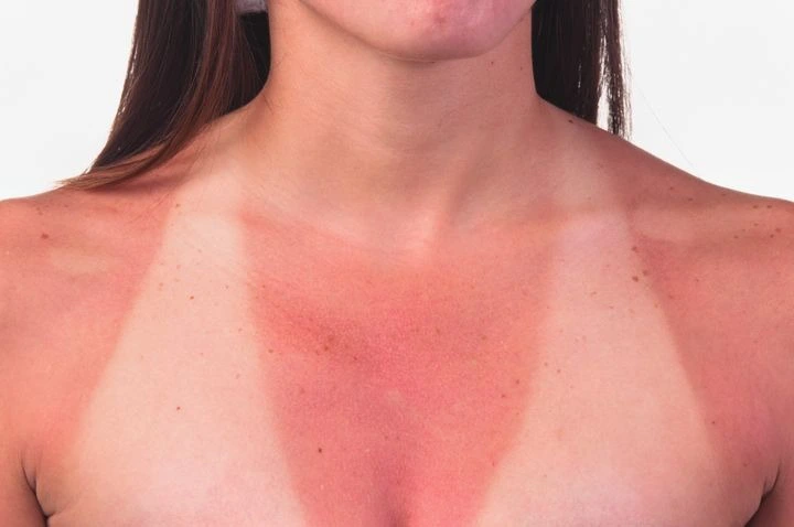 Cách chăm sóc da khi bị cháy nắng