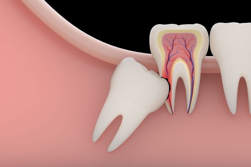 Thời điểm cần phải nhổ răng khôn - Ảnh 1.