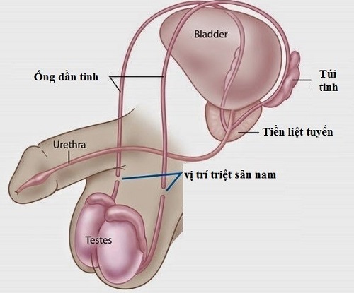 Đảo ngược ống dẫn tinh mang lại cơ hội sinh con cho nam giới đã thắt ống dẫn tinh - Ảnh 1.