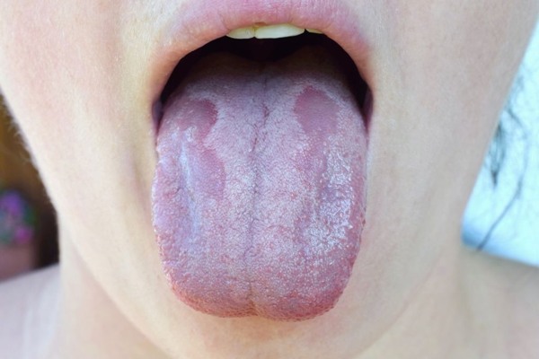 Lưỡi bỗng xuất hiện đốm trắng có thể là dấu hiệu của 3 thứ bệnh - Ảnh 1.