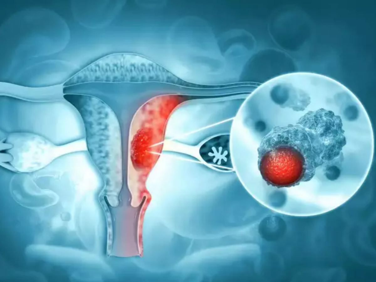 Những dấu hiệu của ung thư âm hộ dễ bị chẩn đoán sang bệnh nhiễm trùng nấm men - Ảnh 2.