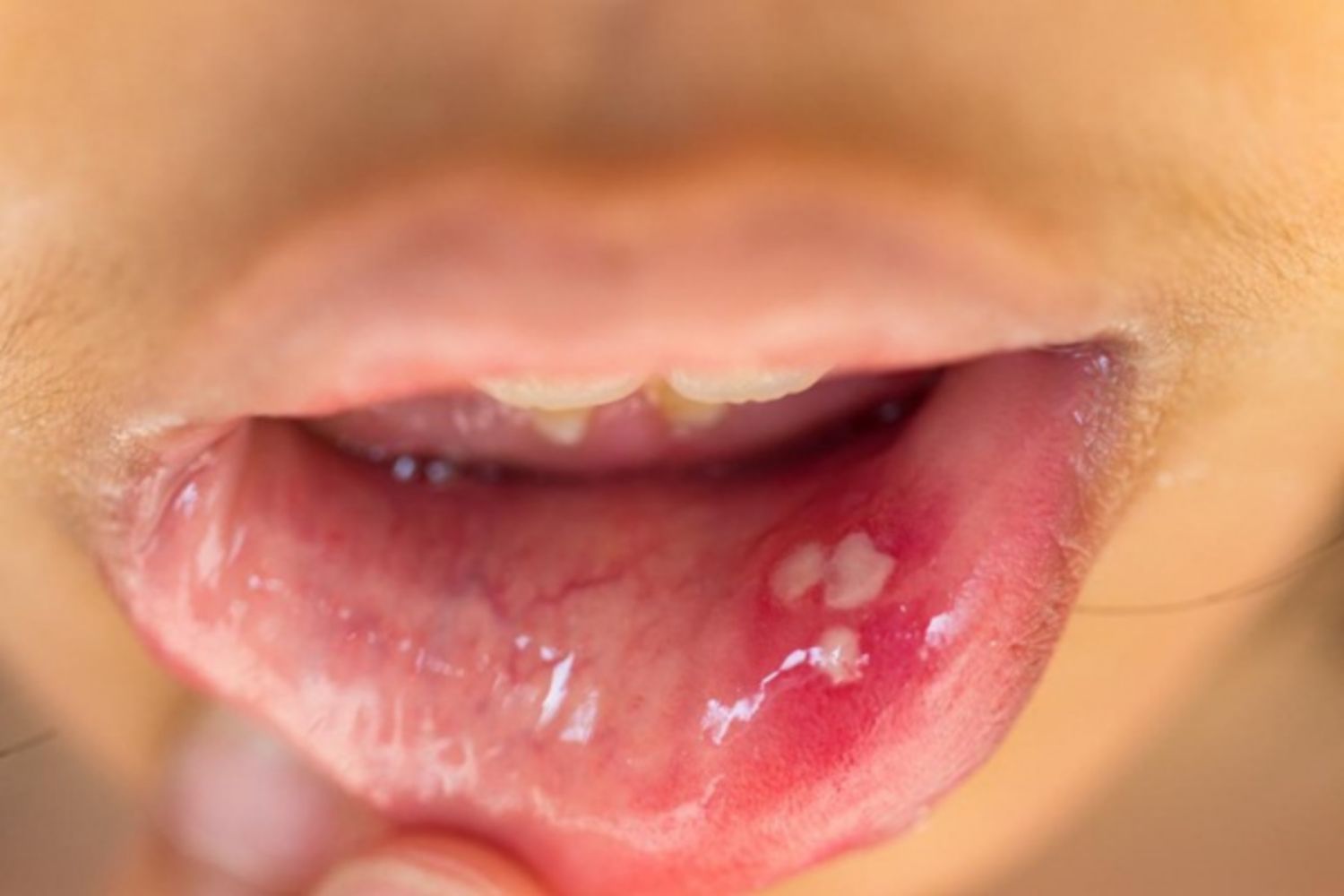 Lưỡi bỗng xuất hiện đốm trắng có thể là dấu hiệu của 3 thứ bệnh - Ảnh 4.