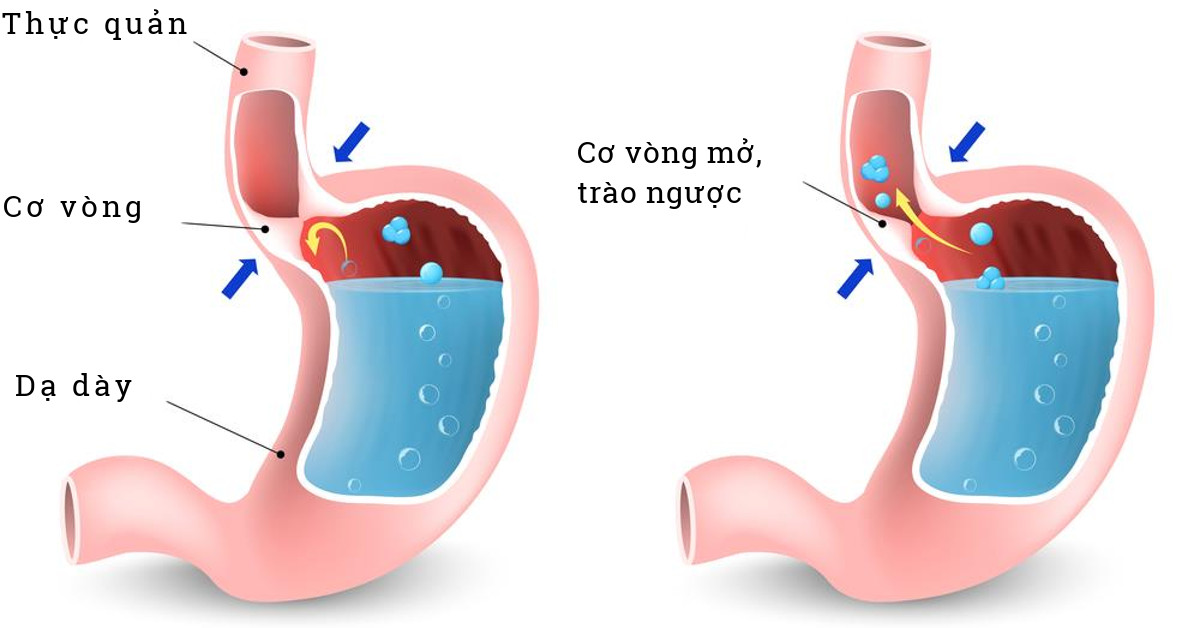 Cải thiện chứng nóng rát, buồn nôn, ợ chua, khó nuốt do trào ngược axit khi mang thai - Ảnh 1.