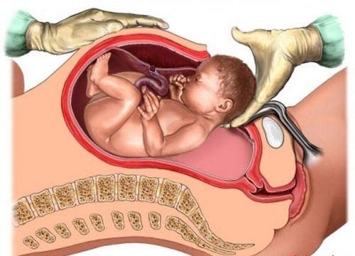 Nghiên cứu mới nhất của Úc cho thấy một điều đặc biệt ở trẻ sinh mổ - Ảnh 1.
