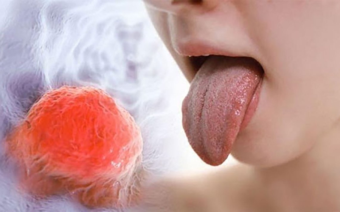 Ung thư lưỡi đáng sợ thế nào? Chuyên gia chỉ rõ 5 nhóm người này sẽ có nguy cơ cao