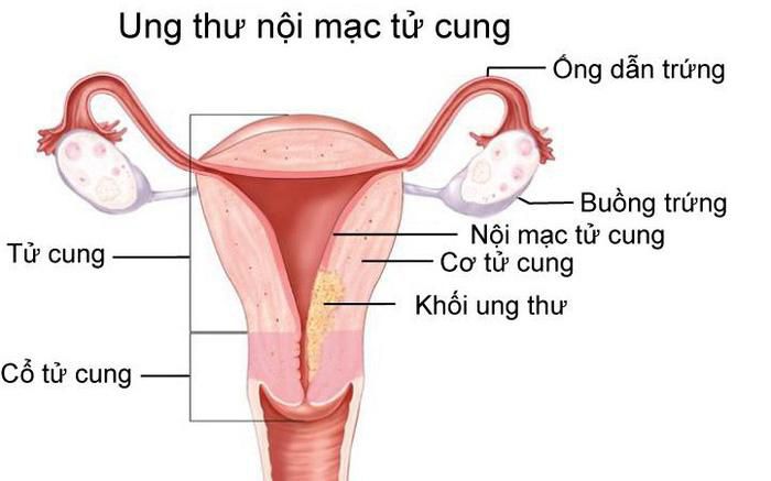 Những dấu hiệu nghi ngờ ung thư nội mạc tử cung - Ảnh 1.