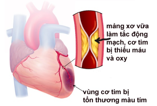 U50, bất kể nam hay nữ nếu có dấu hiệu này cần cảnh giác nhồi máu cơ tim - Ảnh 3.