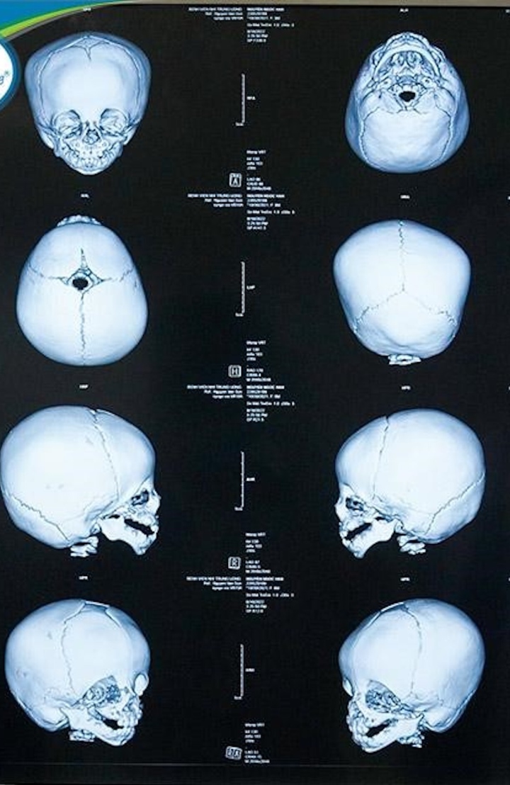 Bé gái 10 tháng tuổi mắc dị tật sọ mặt hiếm gặp - Ảnh 2.