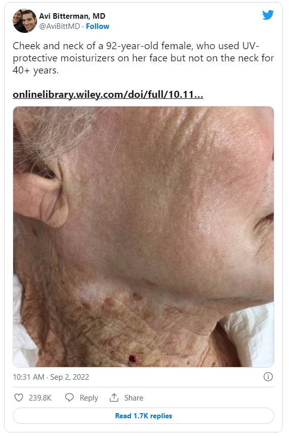 Bức ảnh về người phụ nữ 92 tuổi này là lời nhắc nhở nghiêm khắc cho việc dùng kem chống nắng - Ảnh 2.